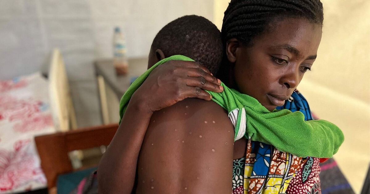 エムポックスは子どもたちにとって命に関わる深刻なリスク 国際NGOワールド・ビジョンが警鐘