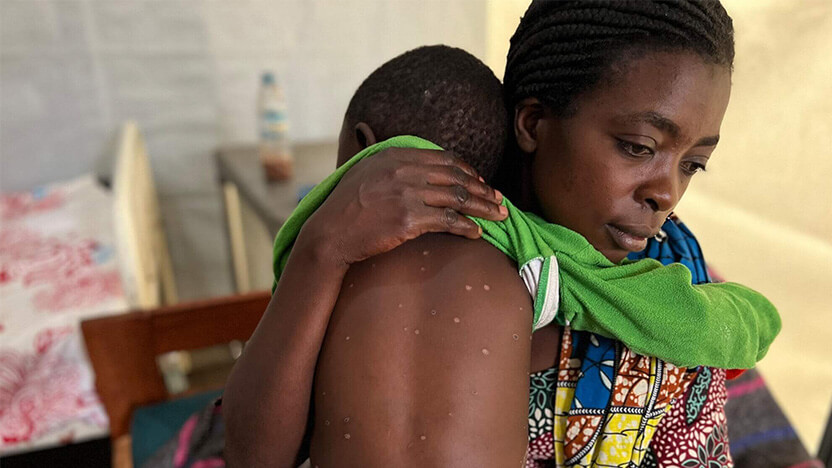 エムポックスに感染した子どもを抱きかかえる母親（コンゴ民主共和国）