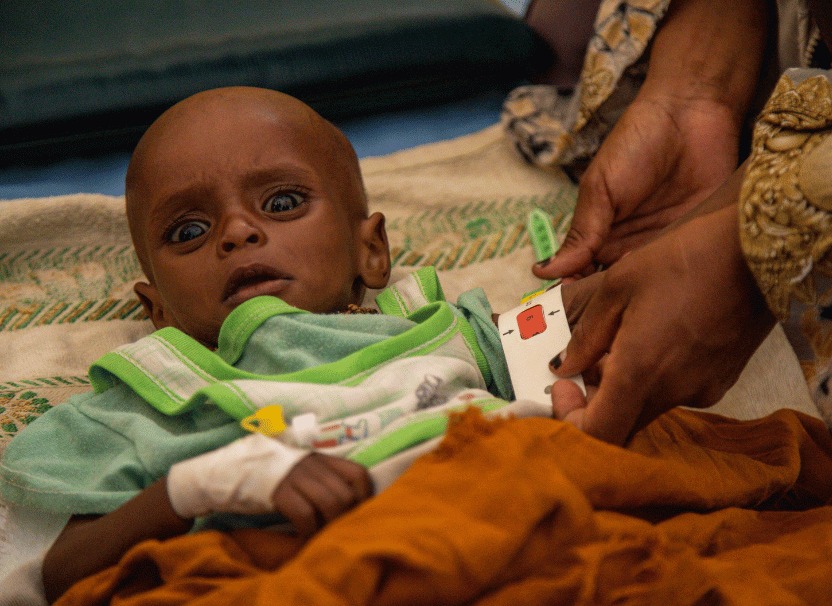 急性栄養不良で治療を受ける子ども