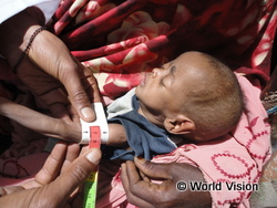 栄養が足りず「生きる権利」が脅かされている子ども(ソマリランド)